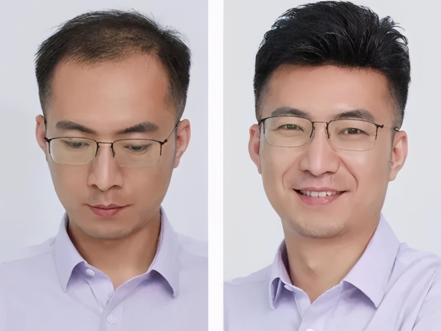 男生发际线太高可以烫发吗,发型设计男生发际线高