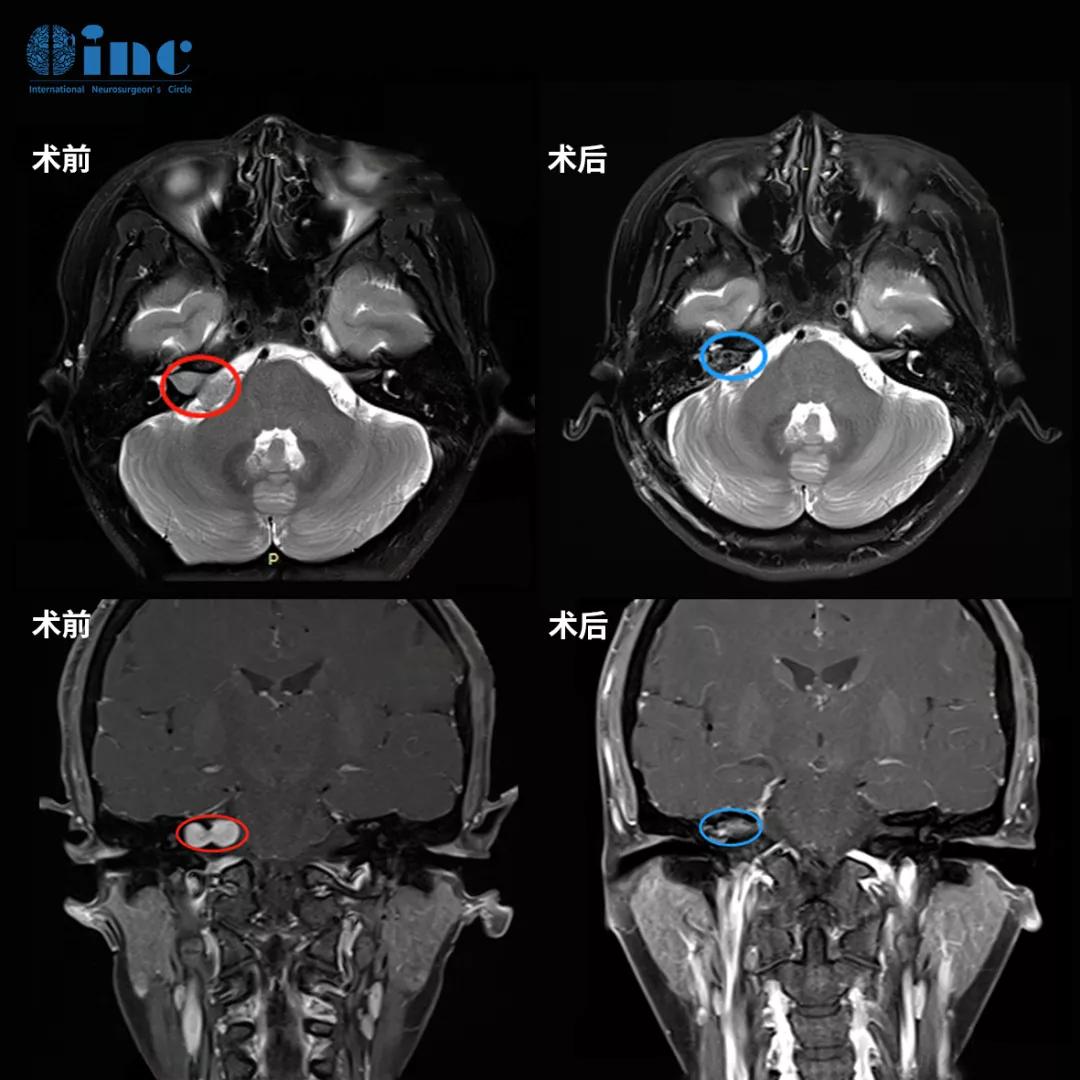 听神经瘤突聋能恢复吗,听神经瘤耳聋了怎么办