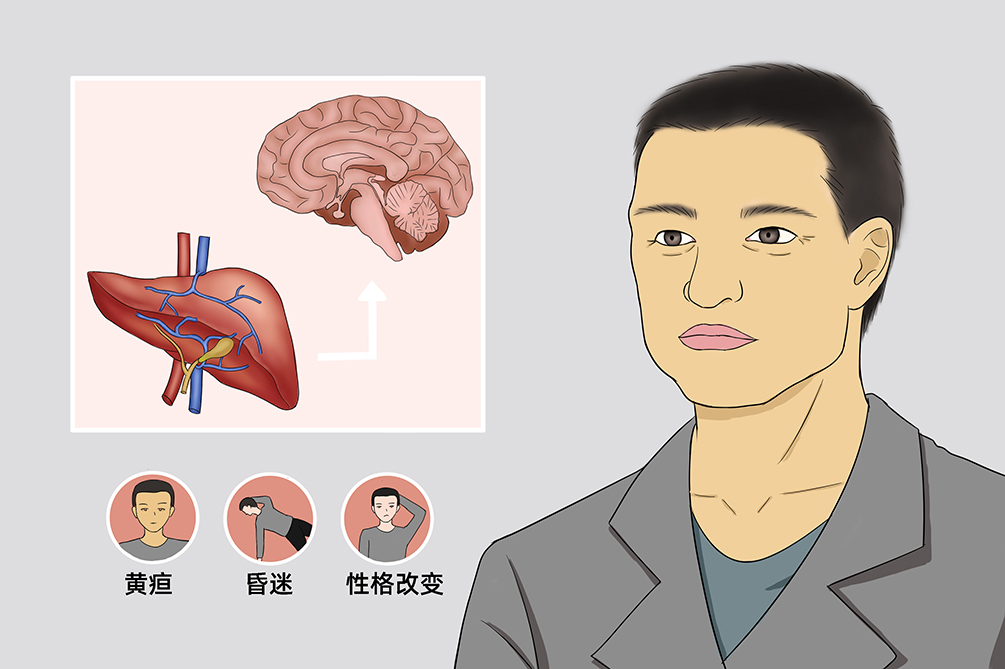 尿素循环障碍什么症状,尿素循环障碍能治好吗