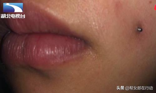 女子打玻尿酸毁容,女子打钢钉致脸发炎视频
