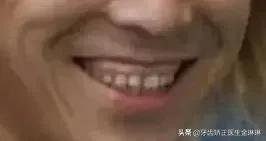 露龈笑对颜值有多大影响,颜值杀露龈笑