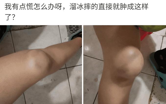 滑冰把膝盖内侧摔了怎么办,溜冰时膝盖磕破怎么办