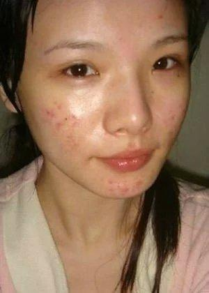 肌肤怎么改善暗黄长痘,暗黄粗糙毛孔大没办法治疗