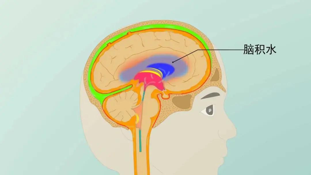 脑室积水有哪些症状,脑积水的水是什么样子