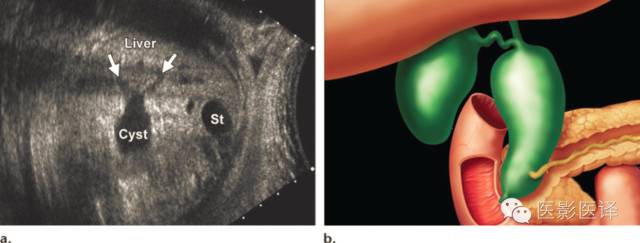 孕早期卵巢囊肿边界清形态规则,孕期卵巢囊肿呈液性伴点状回声