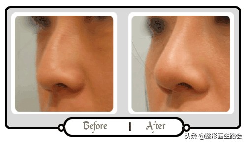 玻尿酸填充鼻子后悔了,玻尿酸注射后悔打溶解酶会不好吗