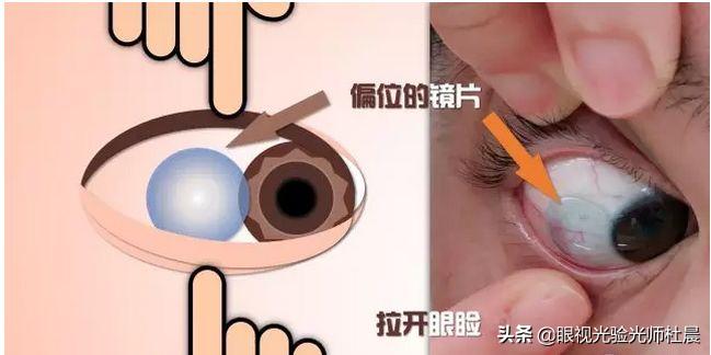 初次戴隐形眼镜感觉有点眩晕,初次戴隐形眼镜怎么取下来