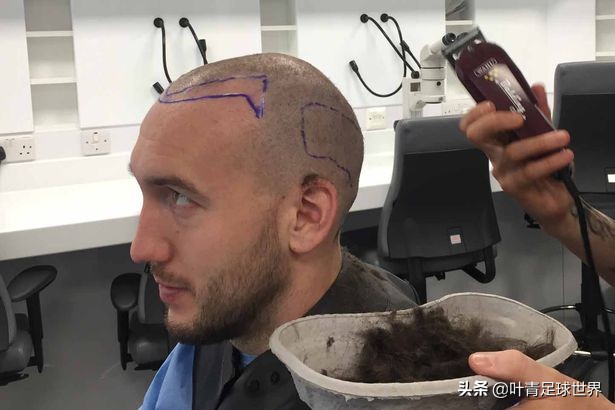 c罗做植发,c罗植发副业史