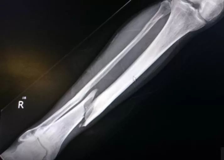 户外受伤该如何紧急处理？