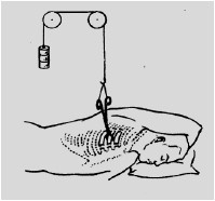 中医诊疗方案肋骨骨折,肋骨骨折的中医治疗方法
