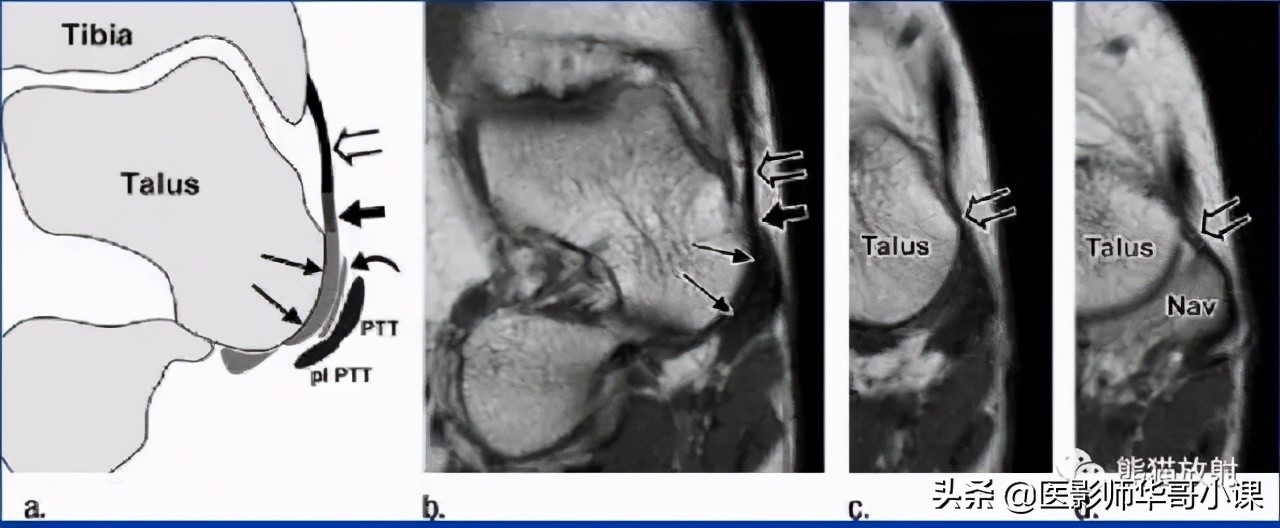 踝关节解剖视频课,解剖学韧带分布图
