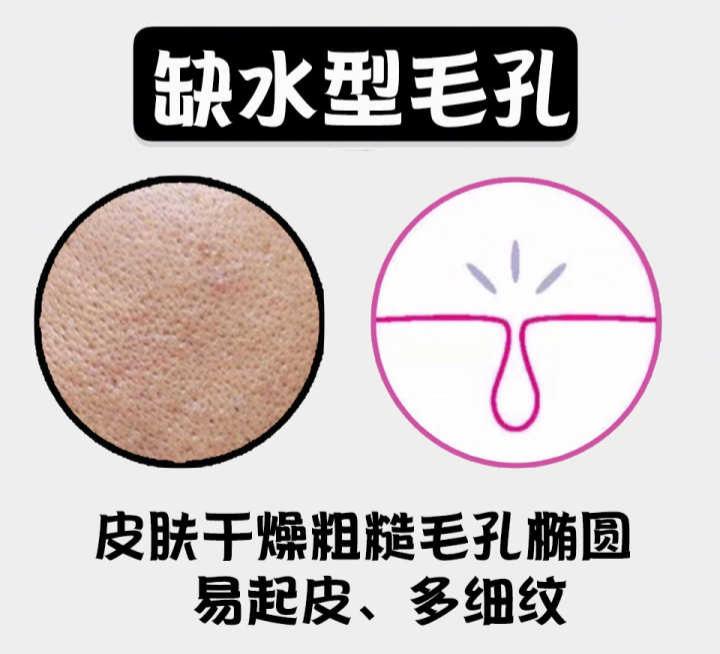 夏季毛孔堵塞怎么办,夏季皮肤毛孔粗大油腻怎么办