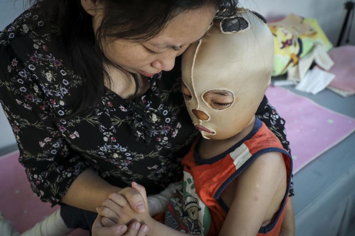 孩子被开水烫伤母亲却只心疼杯子,小孩掉进开水盆80%烫伤