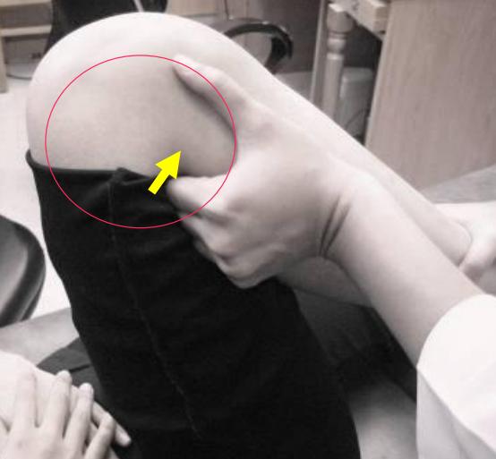 踝关节扭伤两个多月走路还跛脚,踝关节扭伤五个月了走路很痛还肿