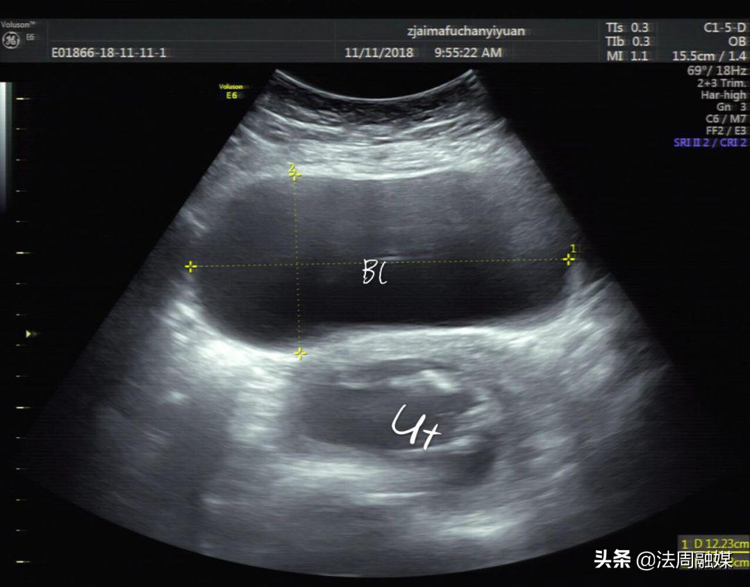 孕妇突发排尿困难，常德妇幼专家：警惕“子宫箝闭”引起的尿潴留