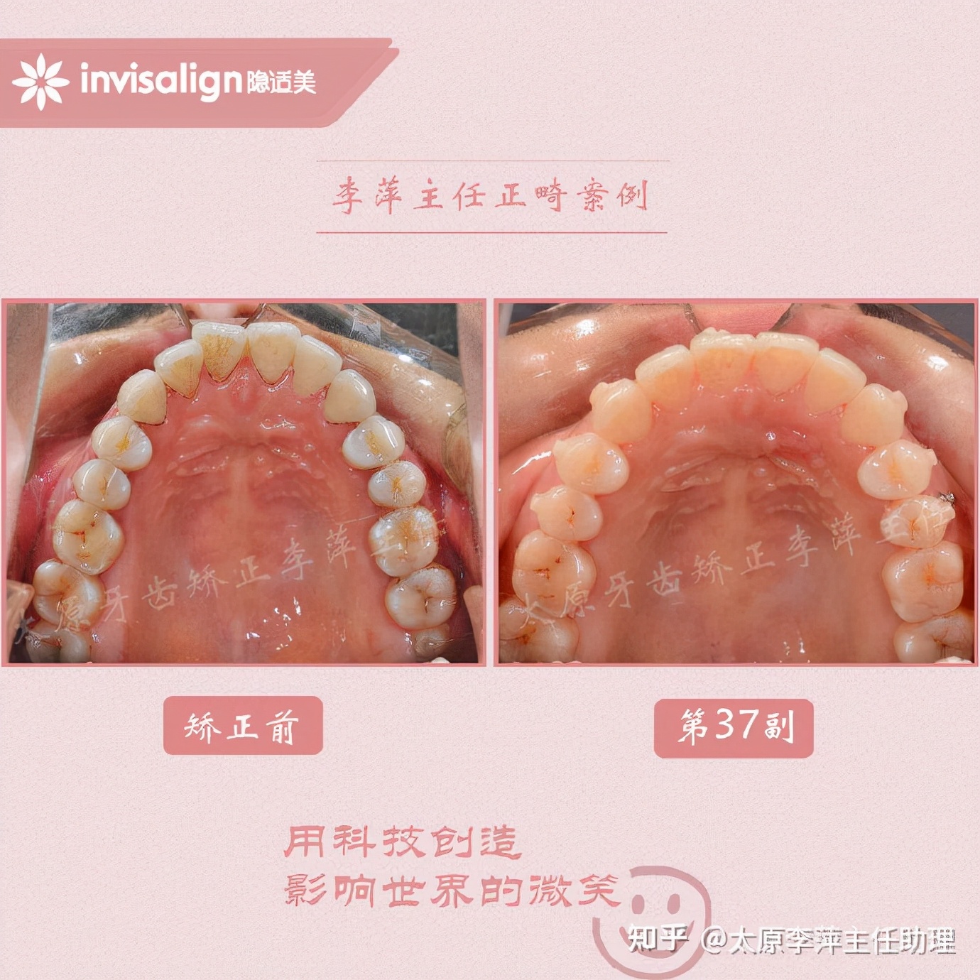重度拥挤矫正牙齿适合隐形牙套吗,广州成人牙齿矫正推荐隐形牙套