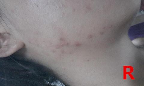 皇家雨燕教你痘痘肌の正确保养方式