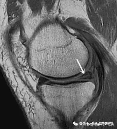 内侧半月板后角损伤怎么治疗,半月板损伤有积液的最好治疗
