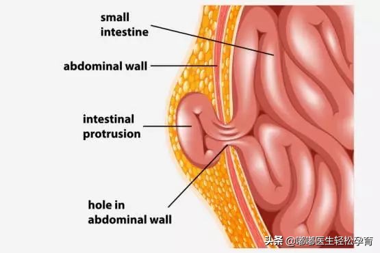 无知父亲,无知家长给新生儿刮胎脂