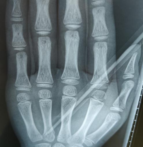 告诉孩子铅笔戳人的危害,孩子手被铅笔戳到什么样子