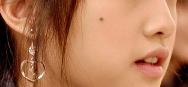 到底要不要祛痣,该不该去医院点痣