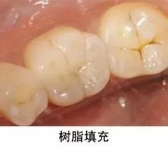 口碑好的补牙齿到底怎么样,补牙材料不对劲
