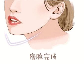 打完瘦脸针几天可以敷面膜,瘦脸针打完后几天出效果