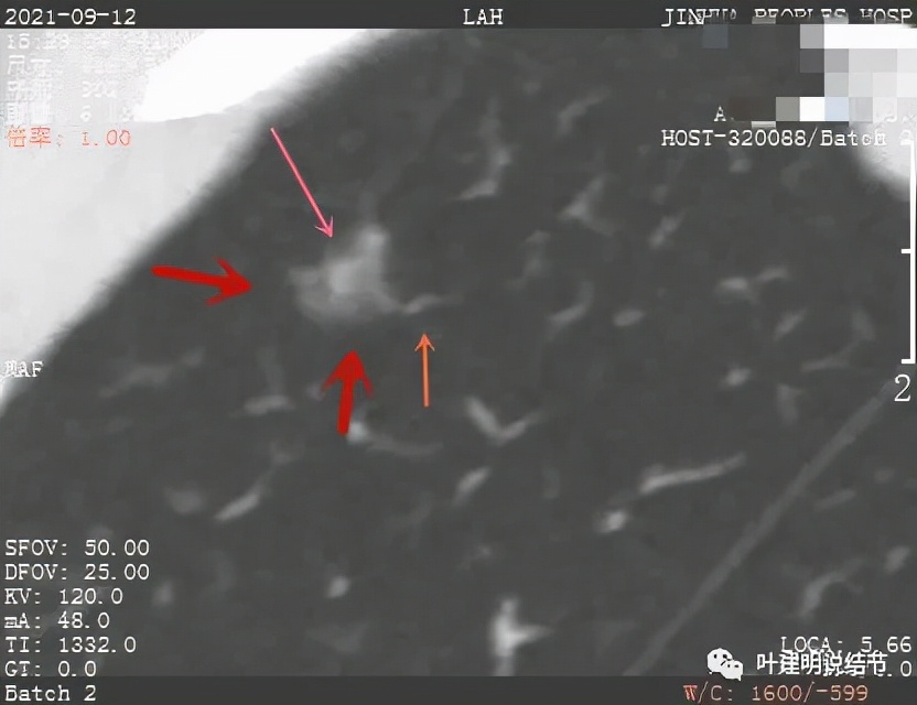 从活检怎么看是非小细胞癌,从病例谈辨证论治