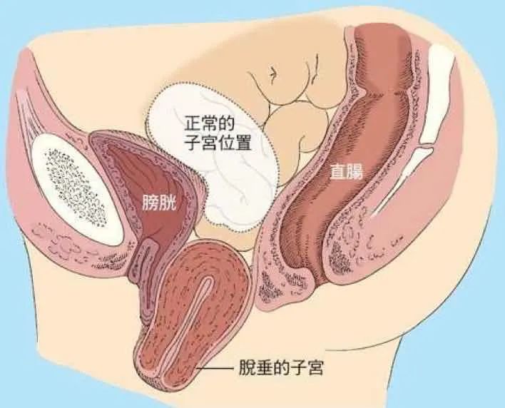 产后漏尿难言之隐,孕后漏尿需要多久可以改善