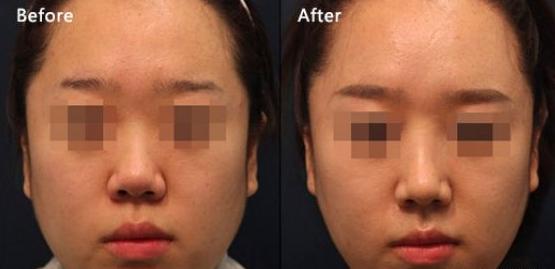 瘦脸针三针是否真的定型,瘦脸针是什么原理有副作用吗