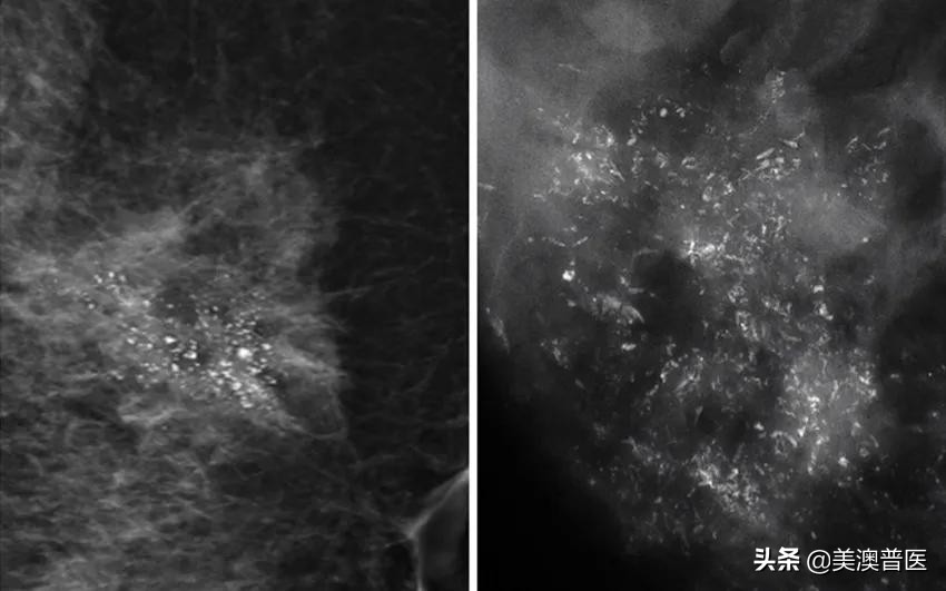 乳腺钙化灶会变成乳腺癌吗,发现乳腺恶性钙化怎么治疗