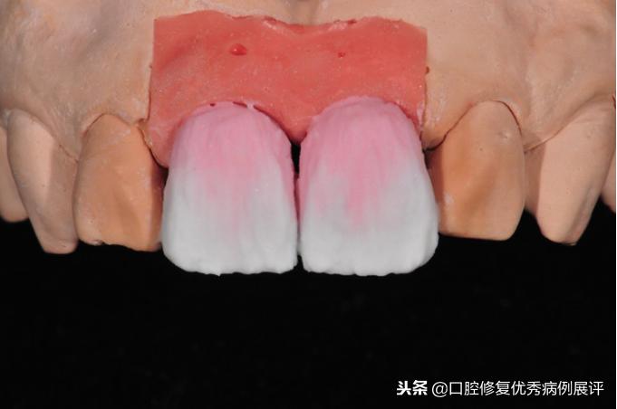 展评优秀病例赏析|Asc全瓷角度基台一体冠进行种植前牙美学修复