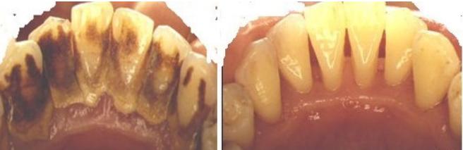 洗牙会导致牙齿敏感吗,洗牙伤害了牙釉质