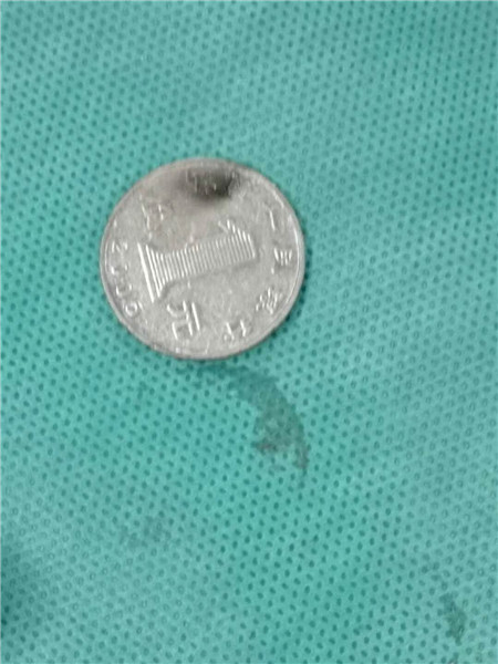 10岁男孩误吞1元硬币卡在喉咙,3岁孩子误吞1元硬币