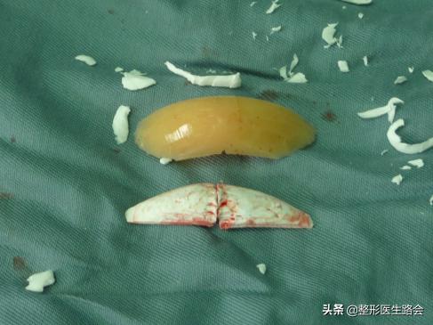 鐗欓娇澶栧嚫涓嬪反鍚庣缉鎬庝箞鐭,涓颁笅宸村彲浠ユ敼鍠勭墮榻垮悗缂╁悧