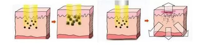 激光美白的效果一般怎么样啊,冷光美白和激光美白哪个效果好