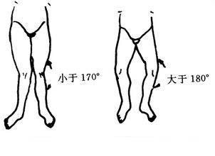 儿童膝内翻去哪里治疗,膝内翻如何矫正儿童