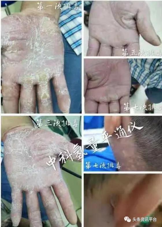 中氢平通仪真的能排毒吗,中科氢量平通仪真的有效果吗