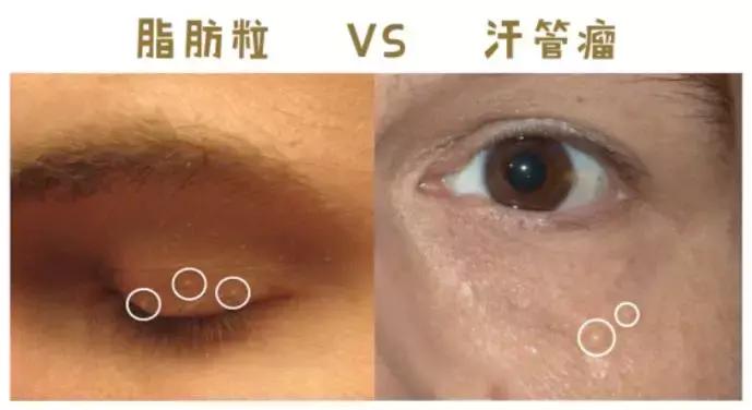 老中医教你一招彻底解决脂肪粒,脸上长脂肪粒怎么解决