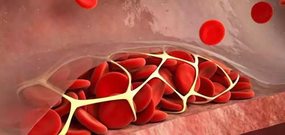 血管有杂质是什么症状,血管里有垃圾和毒素吗