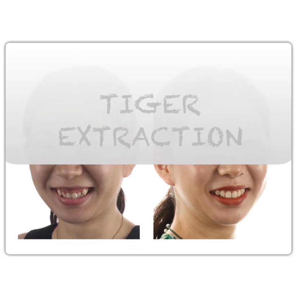 隐适美矫正网上为什么这么便宜,隐适美矫正会不会比预期的快