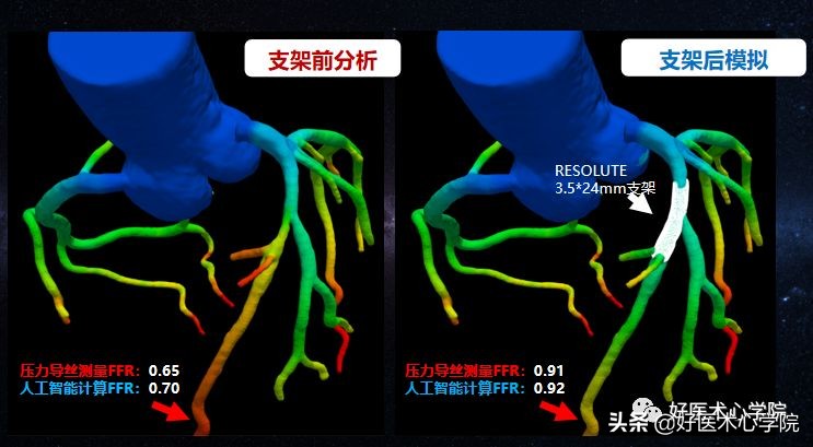 安贞医院冠心病介入治疗新技术,冠心病介入术