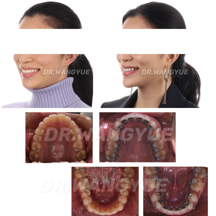 上海舌侧正畸医生,上海舌侧矫正哪家好