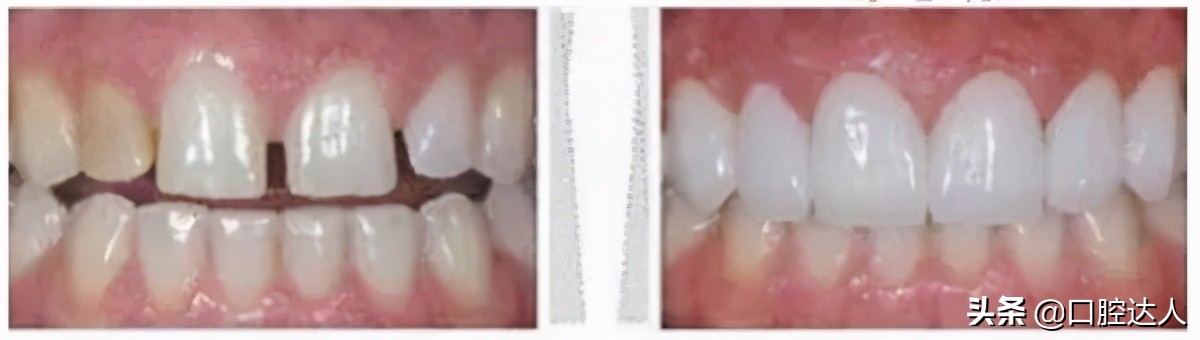 有牙缝做牙齿贴面好还是矫正好,牙缝太大先矫正再做贴面
