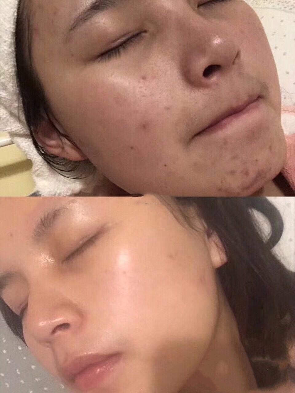 超强祛痘攻略养成不长痘肌肤,祛痘全攻略脸上痘痘真的干净了