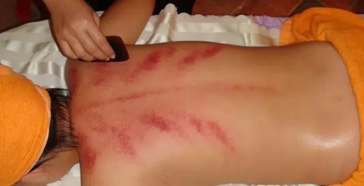 冒冷汗后全身起疙瘩是咋回事,刮痧过后出虚汗是什么原因