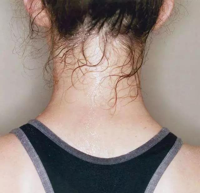 你的鼻头上有黑头怎么办,鼻尖上的黑头怎么处理