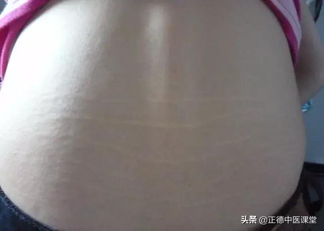 「自诊」肾虚纹，你有吗？