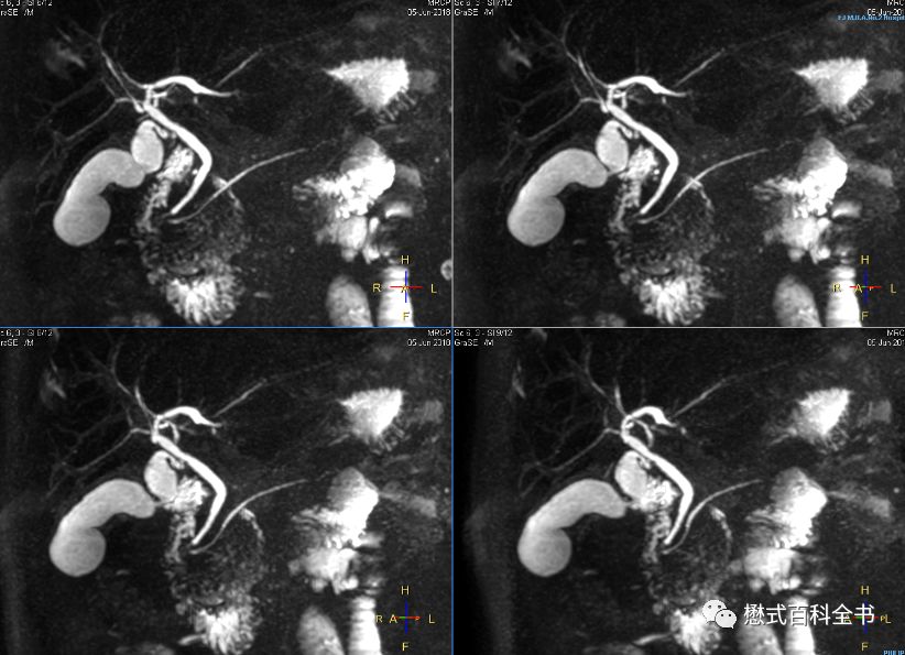开展mrcp技术,mrcp检查操作流程