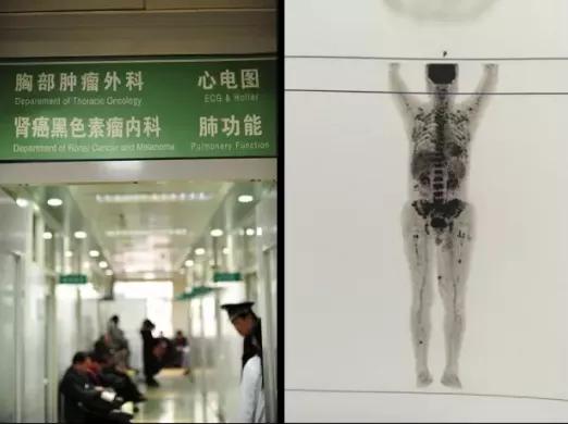 黑痣肿瘤,黑痣恶变的人